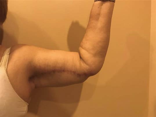 Before & After Arm Lift Patient