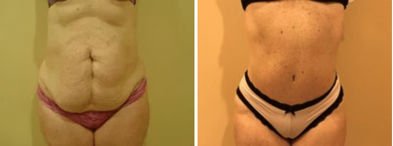 Abdominoplasty and Liposuction to Bilateral Flanks Case #37493 - The  Plastic Surgery Group